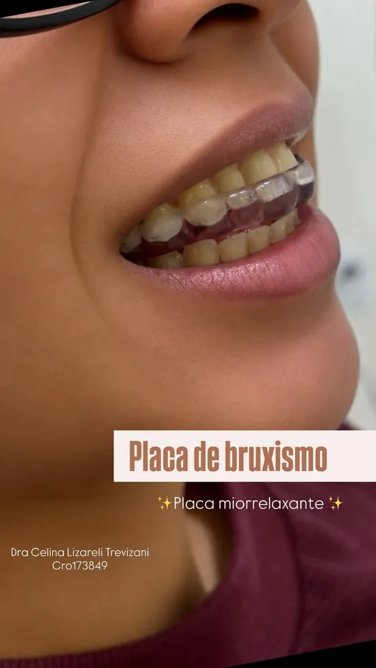 Placa de bruxismo (placa miorrelaxante) instalada.