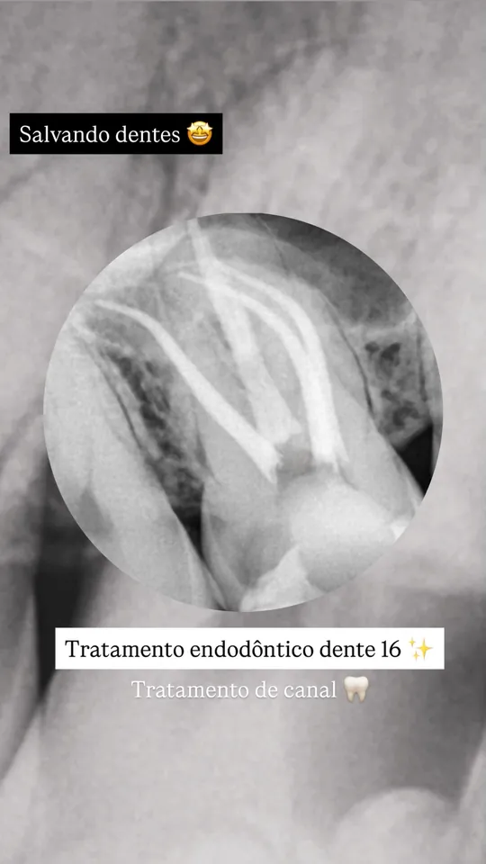 Radiografia: acompanhamento de tratamento endodôntico.