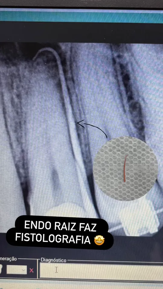 Radiografia durante o tratamento de canal.